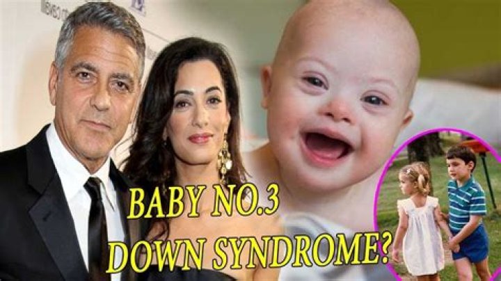 Does George Clooney's Twins Have Down Syndrome?