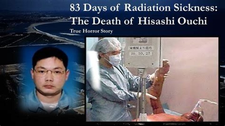 Hisashi Ouchi After Radiation Photo: A Deep Dive Into His Tragic Story