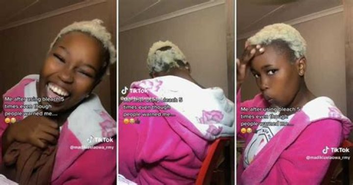 Lady bleached her hair 5 times, leaving her with bald patches where her hair used to be, TikTok video goes viral Lady bleached her hair 5 times, leaving her with bald patches where her hair used to be, TikTok video goes viral