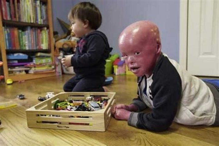 Motivational life story of Evan Fasciano, the boy with deadly skin condition