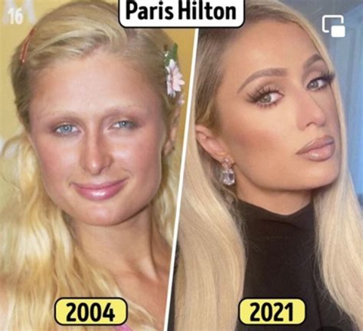 Perez Hilton Plastic Surgery: Before And After Photos