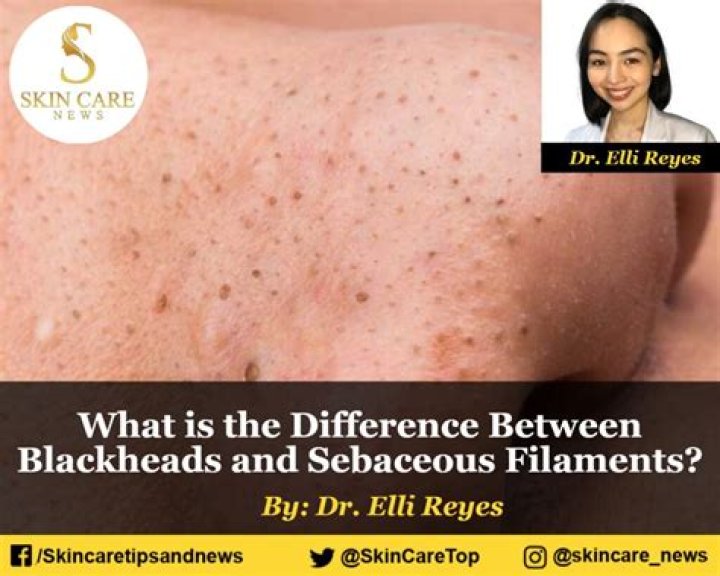 The Real Difference Between Blackheads And Sebaceous Filaments