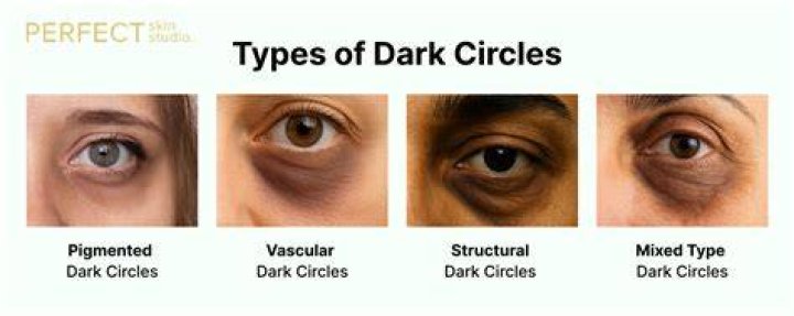 What Are The Different Types Of Dark Circles?